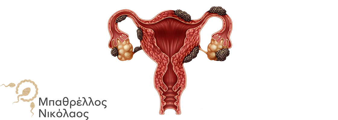 endomitriwsi-kai-ivf